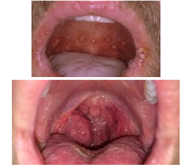 shankr na mindalinax Шанкр