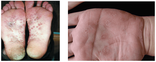 shankr vtorichniy Шанкр