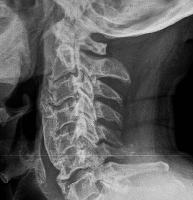 Шейный отдел позвоночника при гиперостозе Форестье