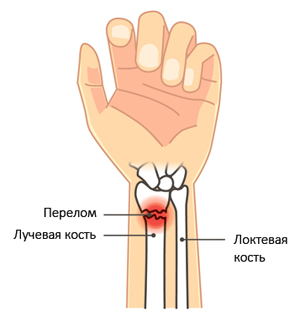 Перелом лучевой кости Перелом лучевой кости