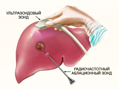 Схема проведения биопсии печени Схема проведения биопсии печени