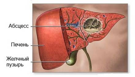 Схематическое изображение абсцесса печени