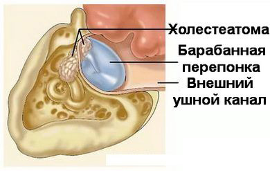 Схематическое изображение холестеатомы уха