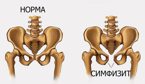 Сравнение симфизита и нормального состояния костей таза Сравнение симфизита и нормального состояния костей таза