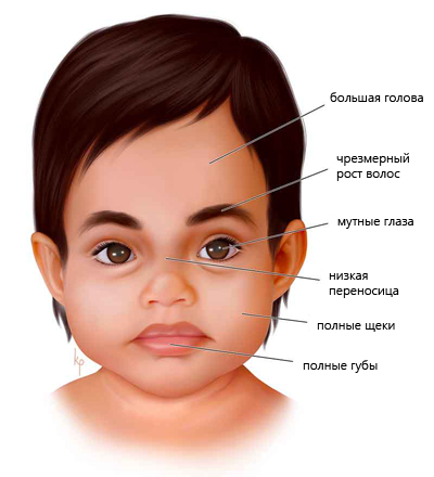 Симптомы синдрома Гурлер Симптомы синдрома Гурлер