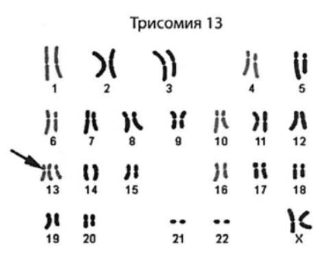 sindrom-patau-trisomiya-13 1 Синдром Патау (трисомия 13)