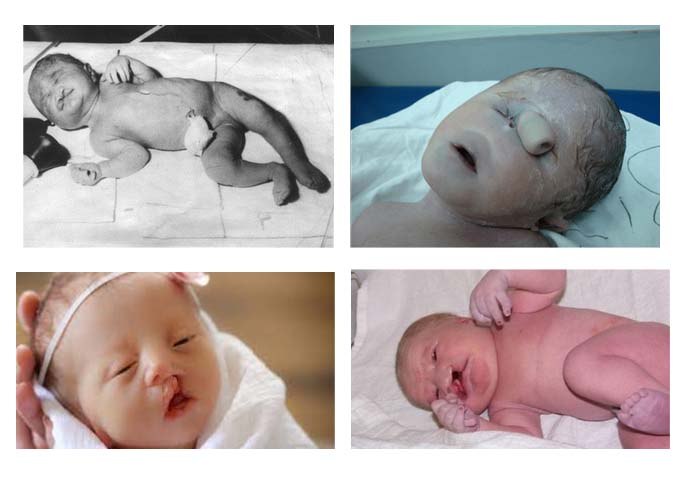 sindrom-patau-trisomiya-13 2 Синдром Патау (трисомия 13)