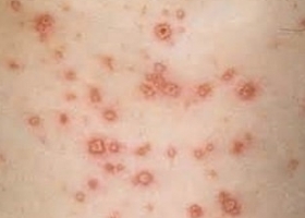 сыпной тиф сыпной тиф