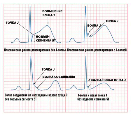 Синдром ранней реполяризации желудочков на ЭКГ Синдром ранней реполяризации желудочков на ЭКГ