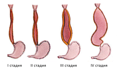 Стадии ахалазии кардии Стадии ахалазии кардии