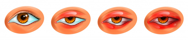 Стадии развития блефарита Стадии развития блефарита