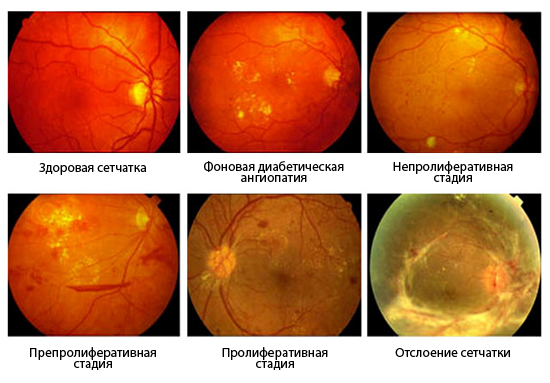 Стадии развития отслоения сетчатки глаза Стадии развития отслоения сетчатки глаза
