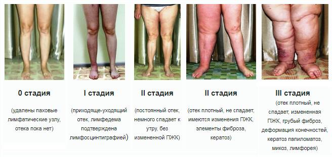 Стадии развития слоновой болезни Элефантиаз