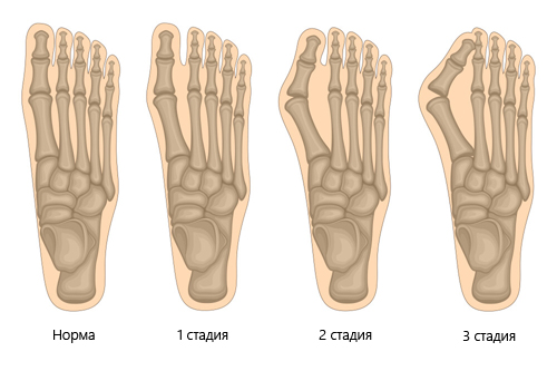 Стадии вальгусной деформации Стадии вальгусной деформации