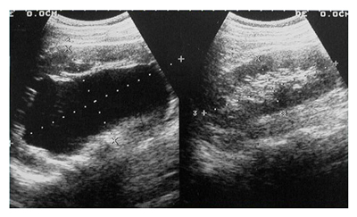 Стадия выраженного гидронефроза на УЗИ Стадия выраженного гидронефроза на УЗИ