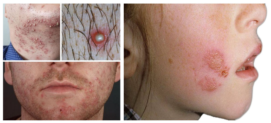 stafilokokk 1 Стафилококк