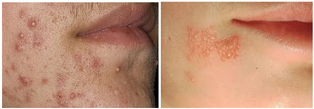 stafilokokk 3 Стафилококк