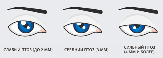 Степени птоза верхнего века Степени птоза верхнего века