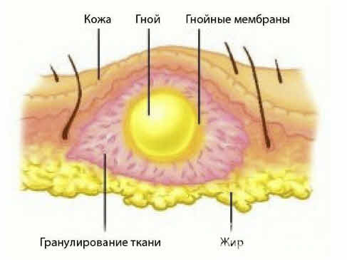 Структура абсцесса