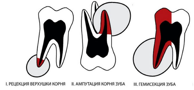 svishh-na-desne lecenie Свищ на десне