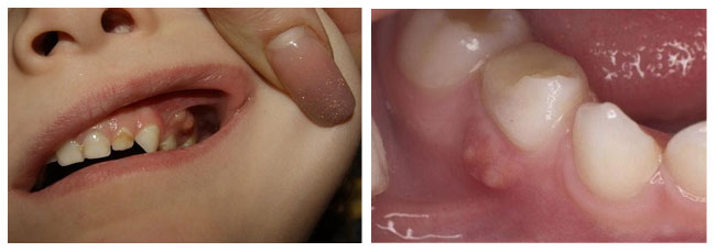 svishh-na-desne u detey