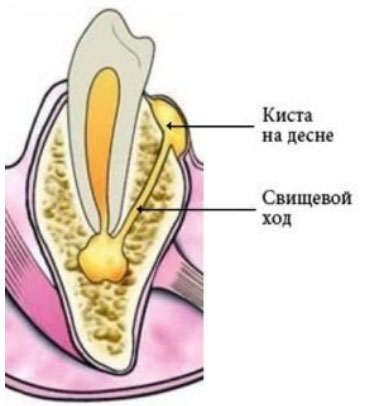 svishh-na-desne zub Свищ на десне