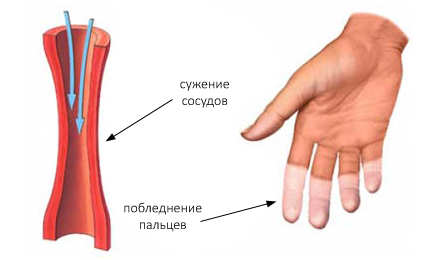 Синдром Рейно Синдром Рейно