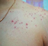 Остиофоликуллит Остиофоликуллит