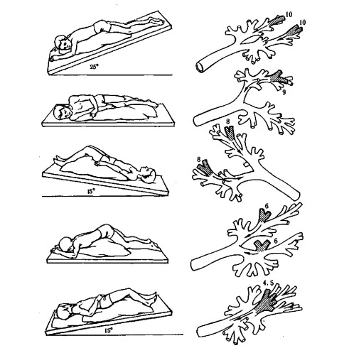 Трахеобронхит Трахеобронхит
