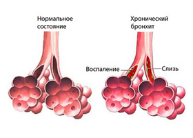 Трахеобронхит Трахеобронхит