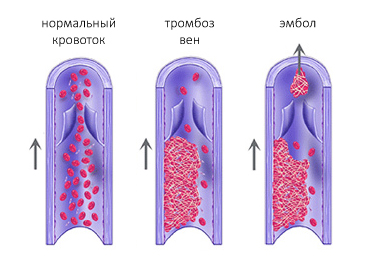 Тромбоз вен Тромбоз вен