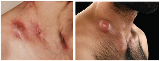 Свищи и рубцы при туберкулезе кожи Свищи и рубцы при туберкулезе кожи