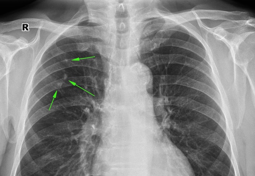 Туберкулез на рентгеновском снимке легких Туберкулез на рентгеновском снимке легких