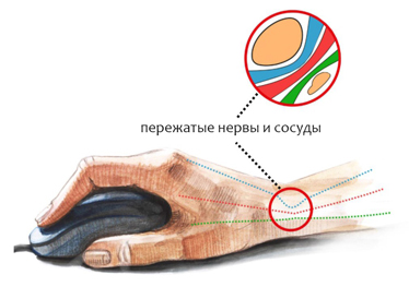 Туннельный синдром Туннельный синдром