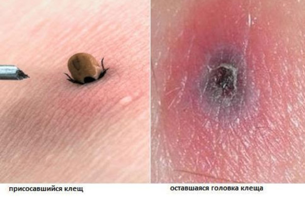 ukus-kleshha vidy Укус клеща