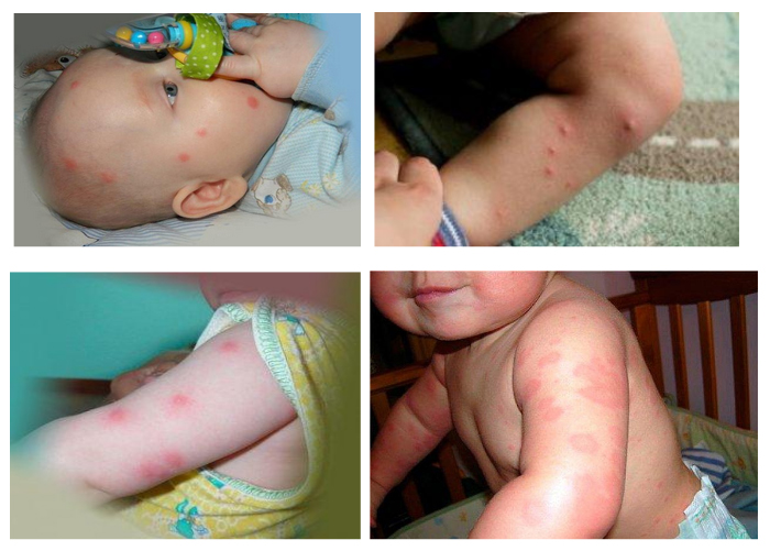 ukusy-bloh 21 Укусы блох