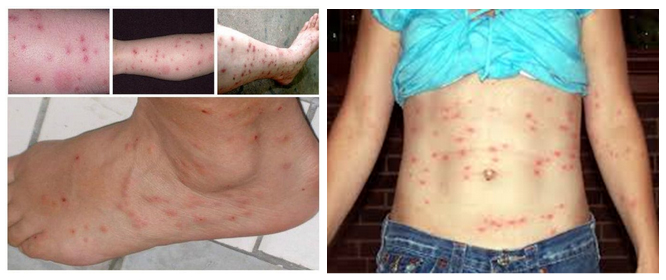 ukusy-bloh 8 Укусы блох