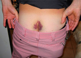 ushib-i-perelom-kopchika 2 Ушиб и перелом копчика