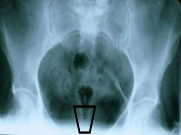 ushib-i-perelom-kopchika 3 Ушиб и перелом копчика