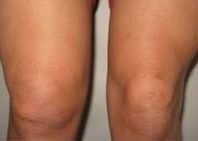 ushib-nogi 1 Ушиб ноги