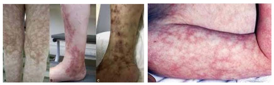 uzelkovyj-periarteriit 2 Узелковый периартериит