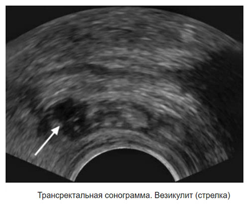 vezikulit-vospal…emennyh-puzyrkov sonogramma Везикулит (воспаление семенных пузырьков)