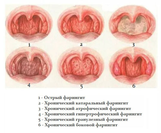 Разновидности фарингита Разновидности фарингита