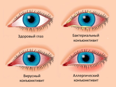 Виды заболевания Виды заболевания