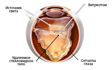Витрэктомия Витрэктомия