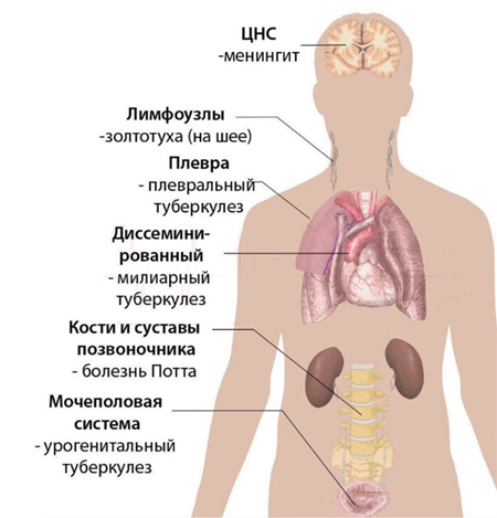 Внелегочные формы туберкулеза Внелегочные формы туберкулеза