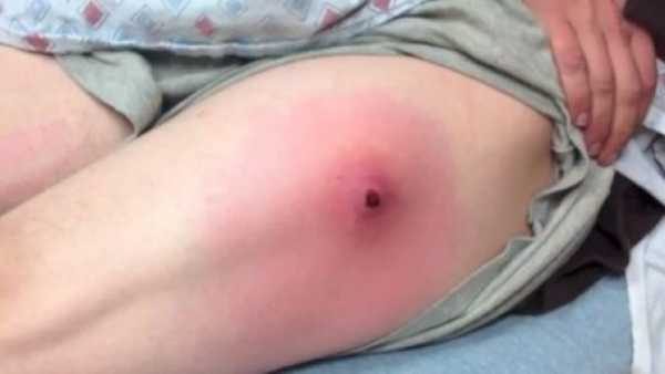 Внешний вид абсцесса