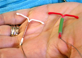 Внутриматочные противозачаточные средства (ВМС) Внутриматочные противозачаточные средства (ВМС)