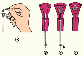 Внутриматочные противозачаточные средства (ВМС) Внутриматочные противозачаточные средства (ВМС)