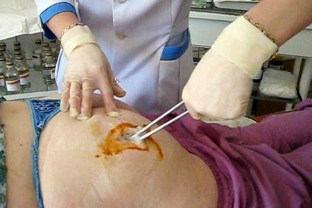 Вскрытие постинъекционного абсцесса ягодичной области